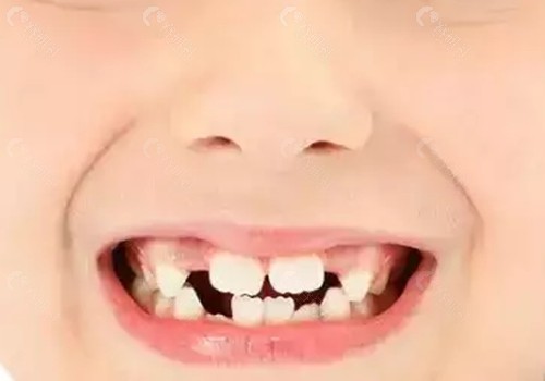 儿童早期牙齿矫正器都有哪几种