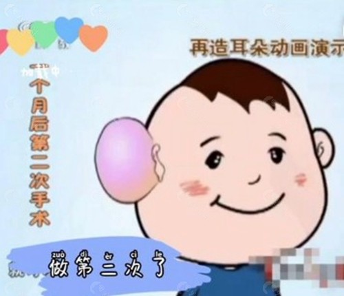 耳再造公益救助行动是否可信？