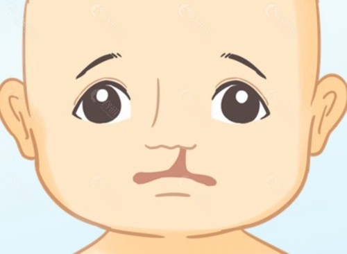 唇腭裂手术多大做比较好？