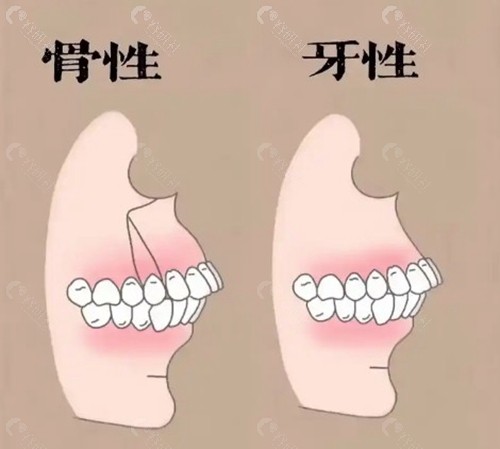 骨性龅牙可以单纯通过牙套矫正吗？