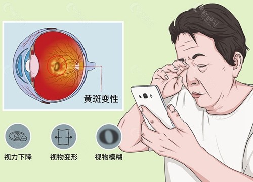 黄斑变性会导致眼睛失明吗