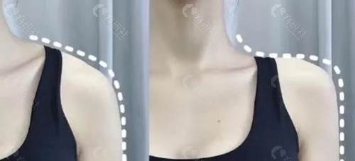 玻尿酸打直角肩价格
