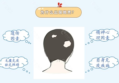 斑秃脱发治疗药物有哪些