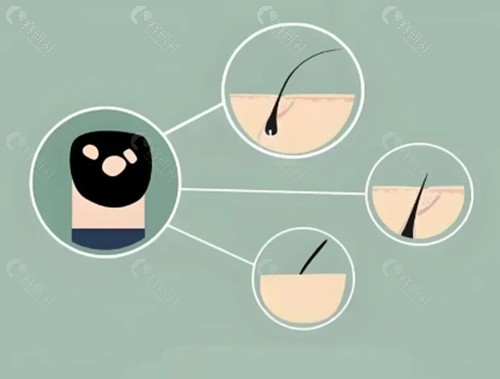 斑秃治疗打针一般需要几次