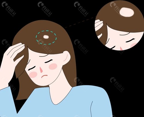 斑秃是什么样子的