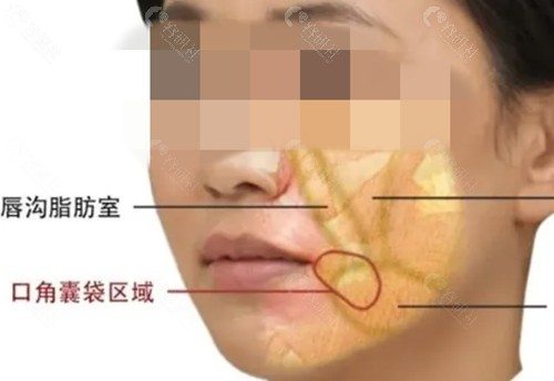 口角囊带做什么医美项目好