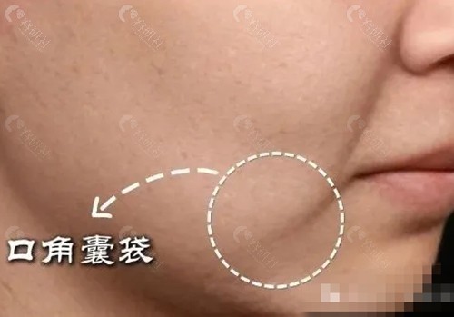 口角囊带打溶脂针好吗