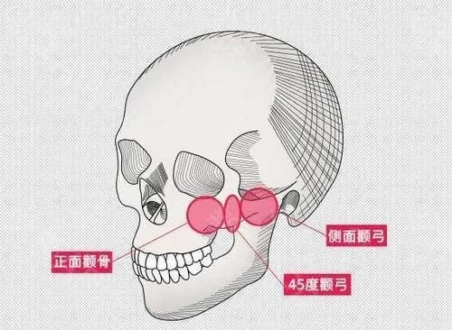 微创降颧骨可靠吗