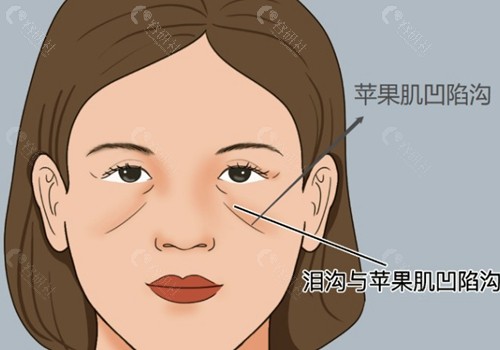 填充面部凹陷一般多少钱一次？