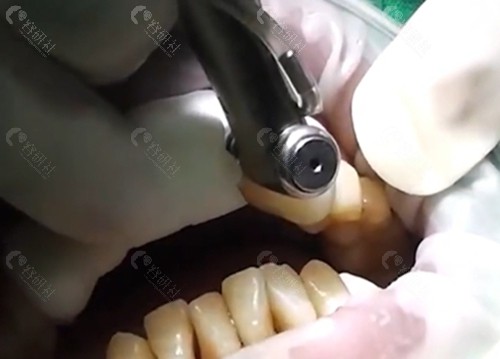 唐山北极星口腔种植牙怎么样