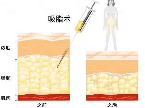 运城蓝山抽脂怎么样