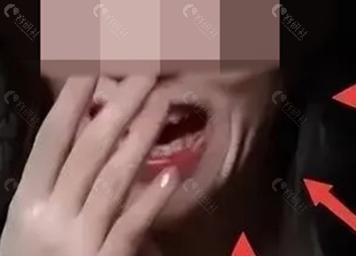 削骨一年后脸塌了图片