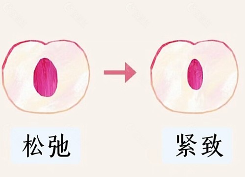 紧缩手术多久能恢复好