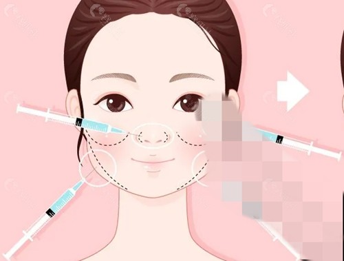 轻薄针多少钱一针