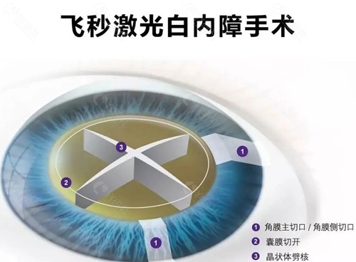 肇庆爱尔眼科白内障手术好吗