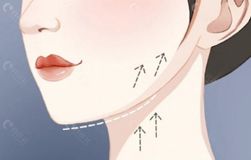 3d钻石网面部提升是什么？