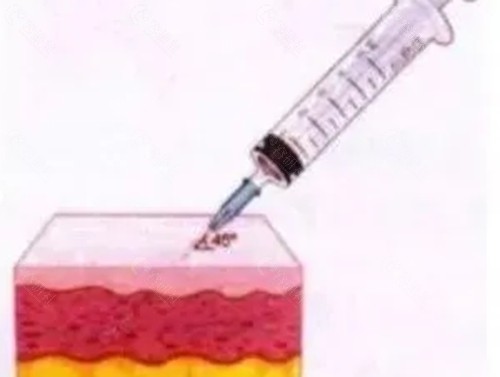 揭阳粤秀整形美容玻尿酸注射好吗