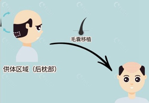 按毛囊数量划分的实际费用参考