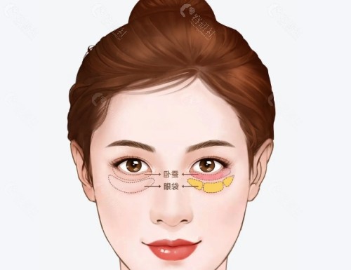 沈阳祛眼袋手术好的医生是谁？