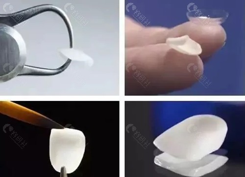 牙齿贴面时间久了掉了还能补吗