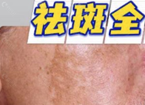 衡水瑞美医疗美容门诊部祛斑好吗