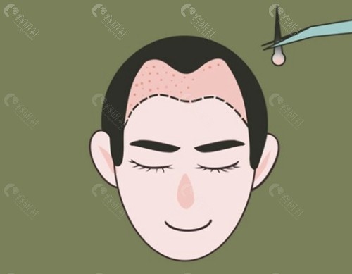 三种主流植发技术对比