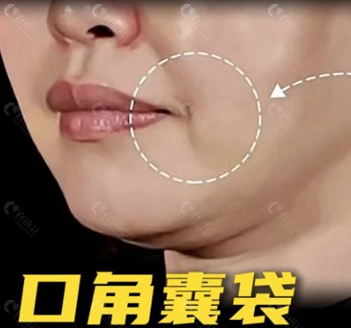 常见的口角囊袋去除方法有哪些？