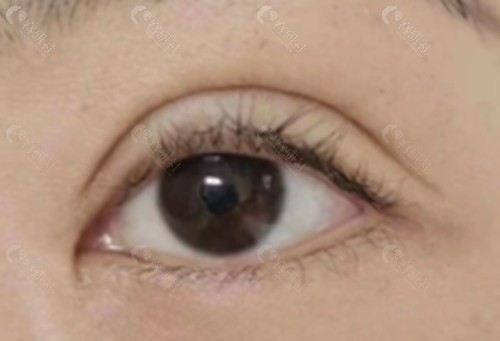 闫威眼修复好吗