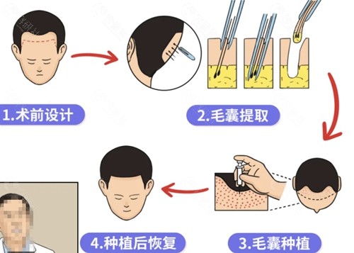 常德伊丽莎白植发怎么样