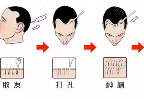 佛山碧莲盛植发好吗