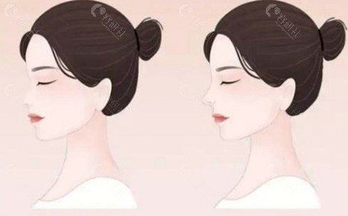 薇丽兰骨雕会栓塞吗？