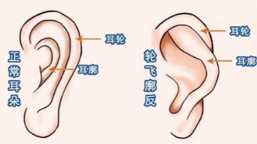 成人反骨耳有哪些整形方法？