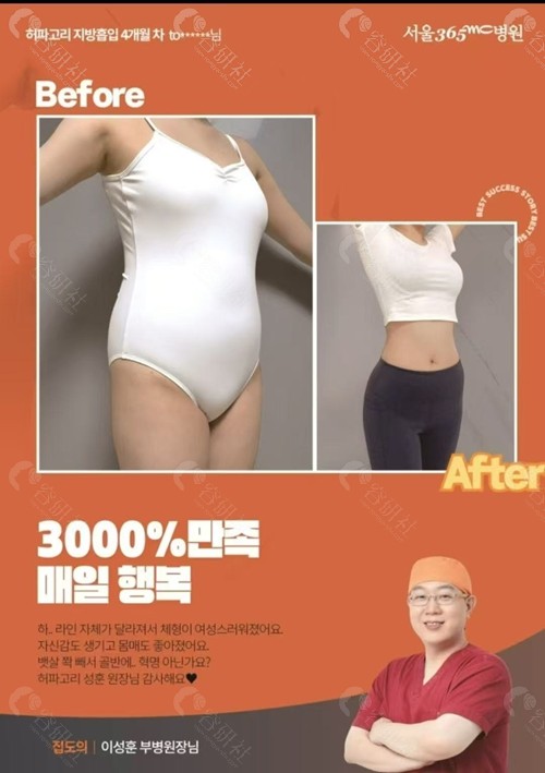 韩国365mc吸脂医院腰腹环吸真实对比
