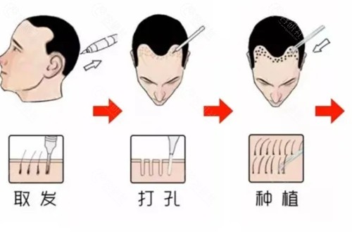 怀化曹家植发好吗