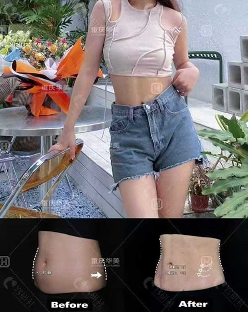 重庆华美整形医院腰腹吸脂真实对比照