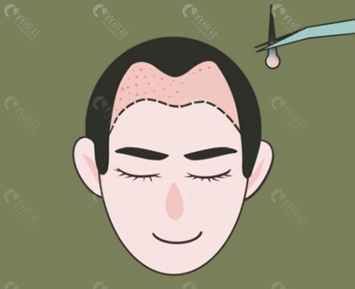 永州不同毛囊单位植发价格