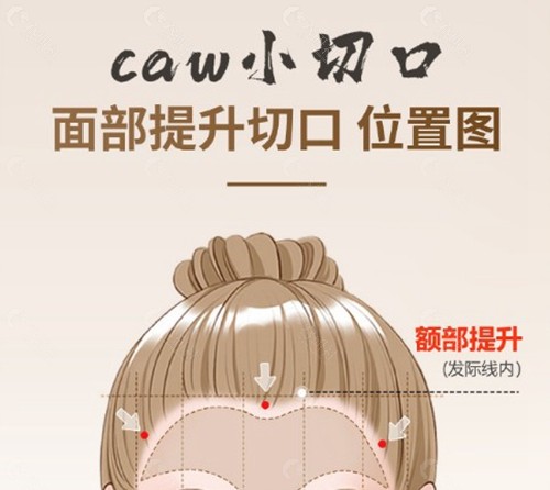 杜太超caw小切口面部提升