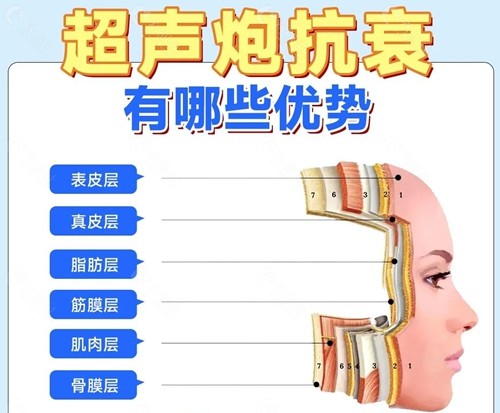 超声炮有哪些优势？
