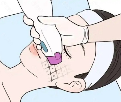 3. 热玛吉（Thermage FLX）