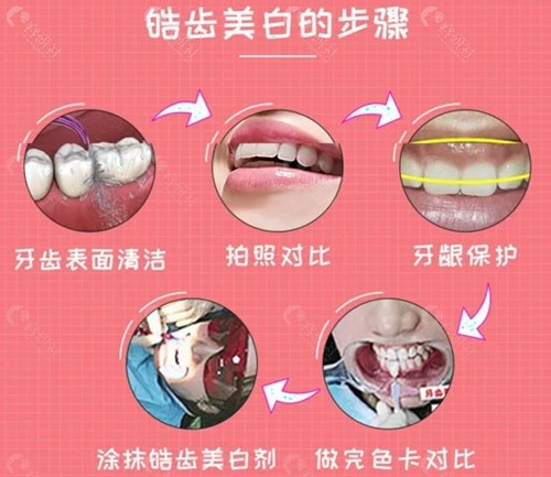 皓齿美白价格