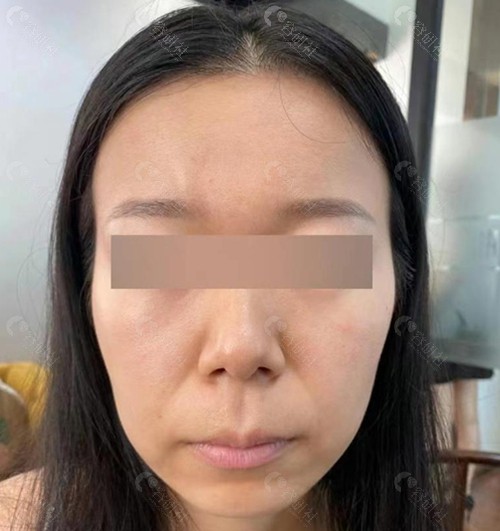 韩国超声刀+法令纹填充术前的我 韩国超声刀+法令纹填充术前的我