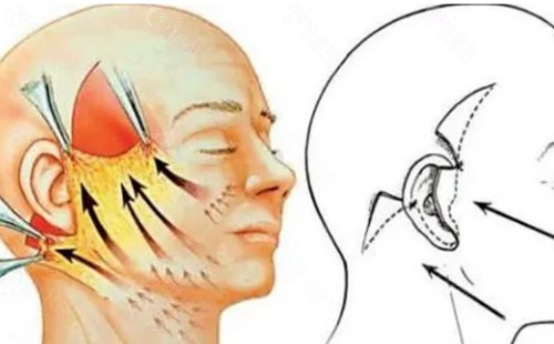国内拉皮手术口碑好的医生