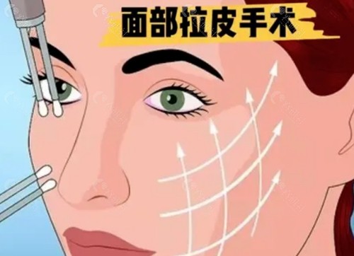 北京拉皮手术医生