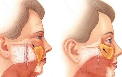 西安拉皮手术医生