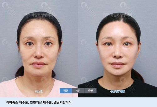 韩国TAILOR卓佑炫整形外科医院额头缩小对比图