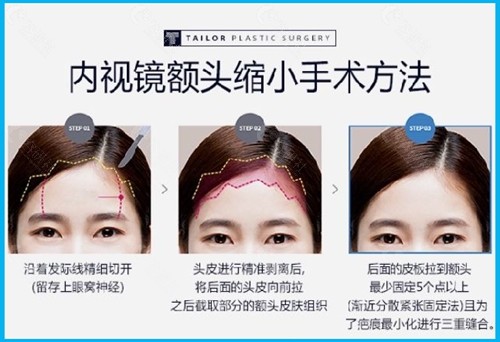 韩国TAILOR卓佑炫整形外科医院额头缩小手术方法