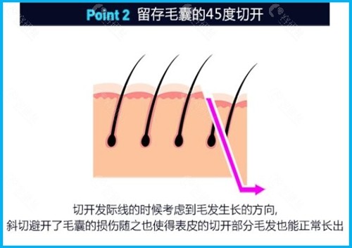 韩国TAILOR卓佑炫整形外科医院额头缩小手术特点