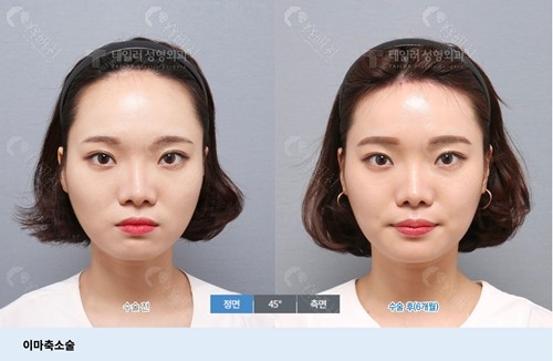 韩国TAILOR卓佑炫整形外科医院额头缩小图片分享