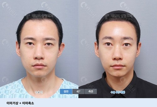 韩国TAILOR卓佑炫整形外科医院额头缩小术前术后对比图