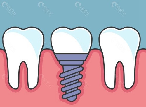 百康特(Bicon)种植牙 百康特(Bicon)种植牙